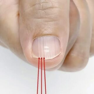 What those vertical lines on your nails really reveal