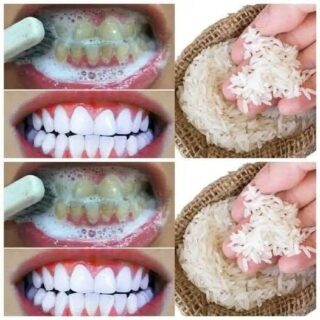RAPID TEETH WHITENING in 1 Minute!