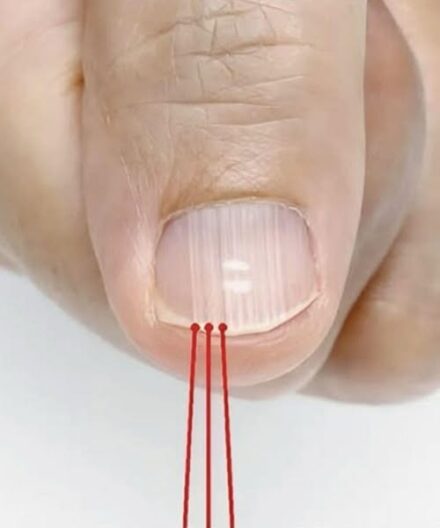 If you have these lines on your nails after 40, it is a clear sign that..