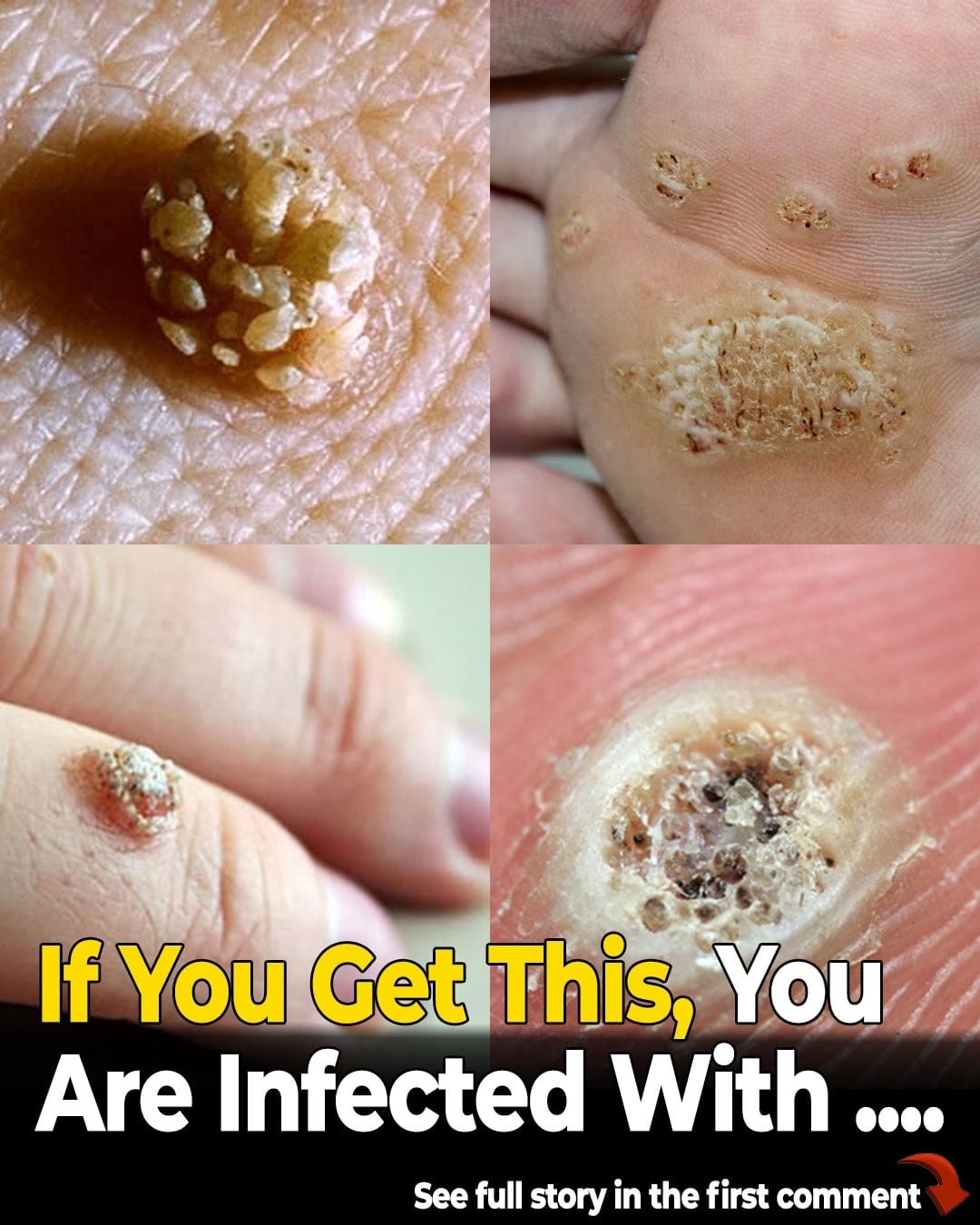 6 Types of Warts (Signs, Symptoms, Home Remedies, and Treatment)